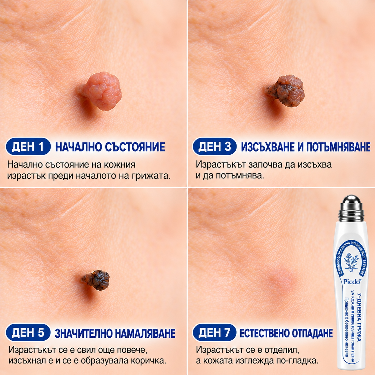 𝐏𝒊𝐜𝐝𝒐®🍒🍒 7-дневна рол-он писалка за премахване на пигментни петна и белези (Без болка, без образуване на нови белези – с ролков апликатор)💪